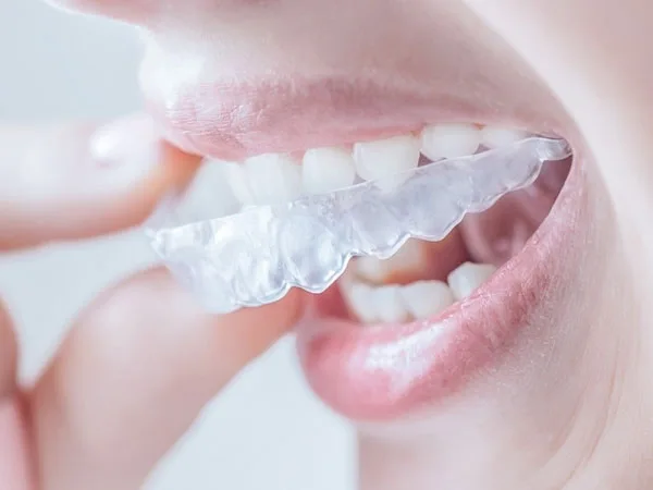 Alinhador transparente removível encaixado nos dentes