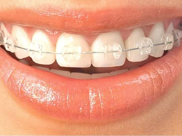 Aparelho ortodôntico estético com peças transparentes no sorriso