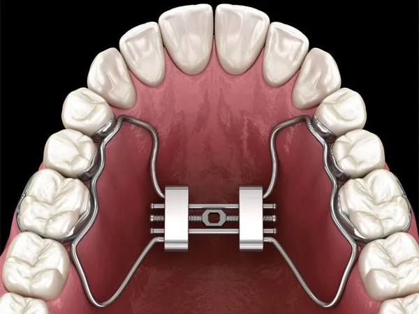 Expansor Hirax ortodôntico instalado no céu da boca