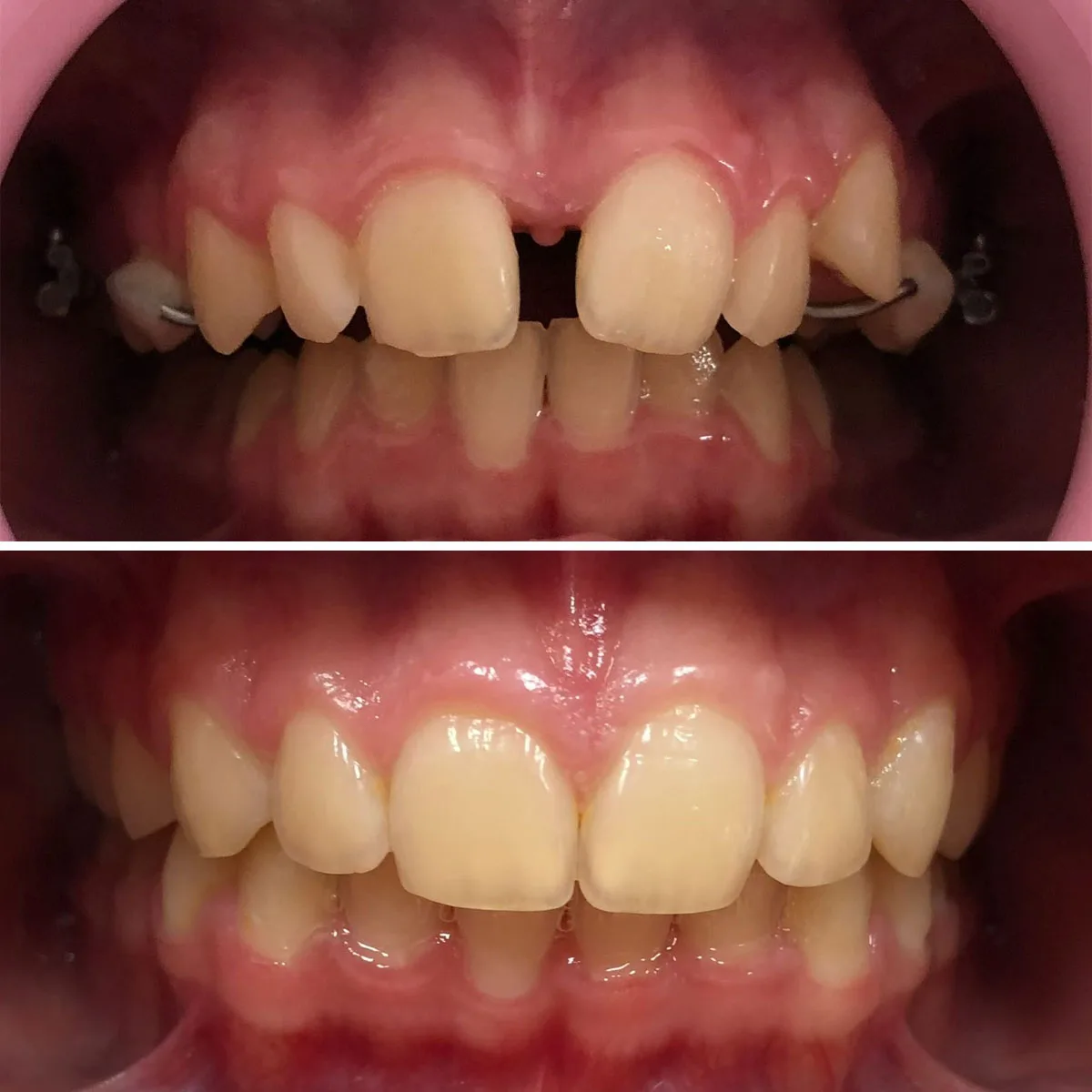 Antes e depois do tratamento ortodôntico da paciente Elisa