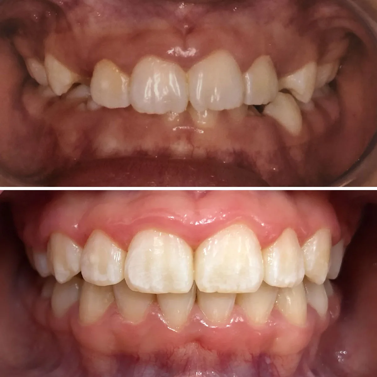 Antes e depois do tratamento ortodôntico infantil da paciente Vitória